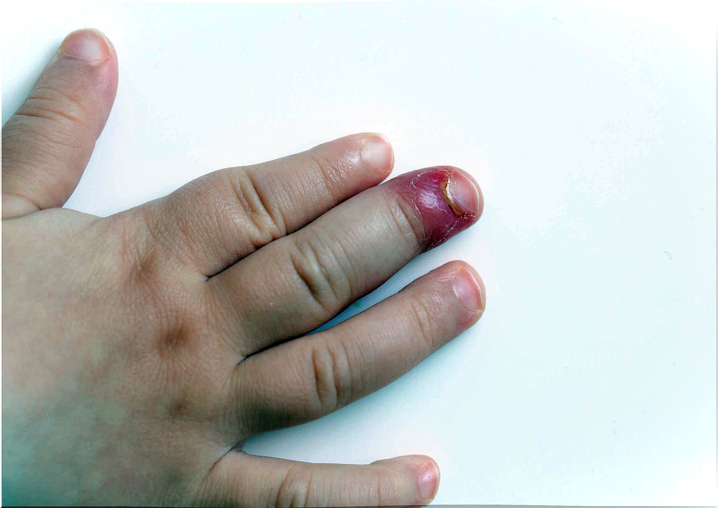 Hand of a child with paronychia.