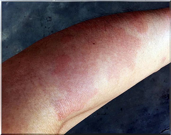 Arm of a person with systemic lupus.