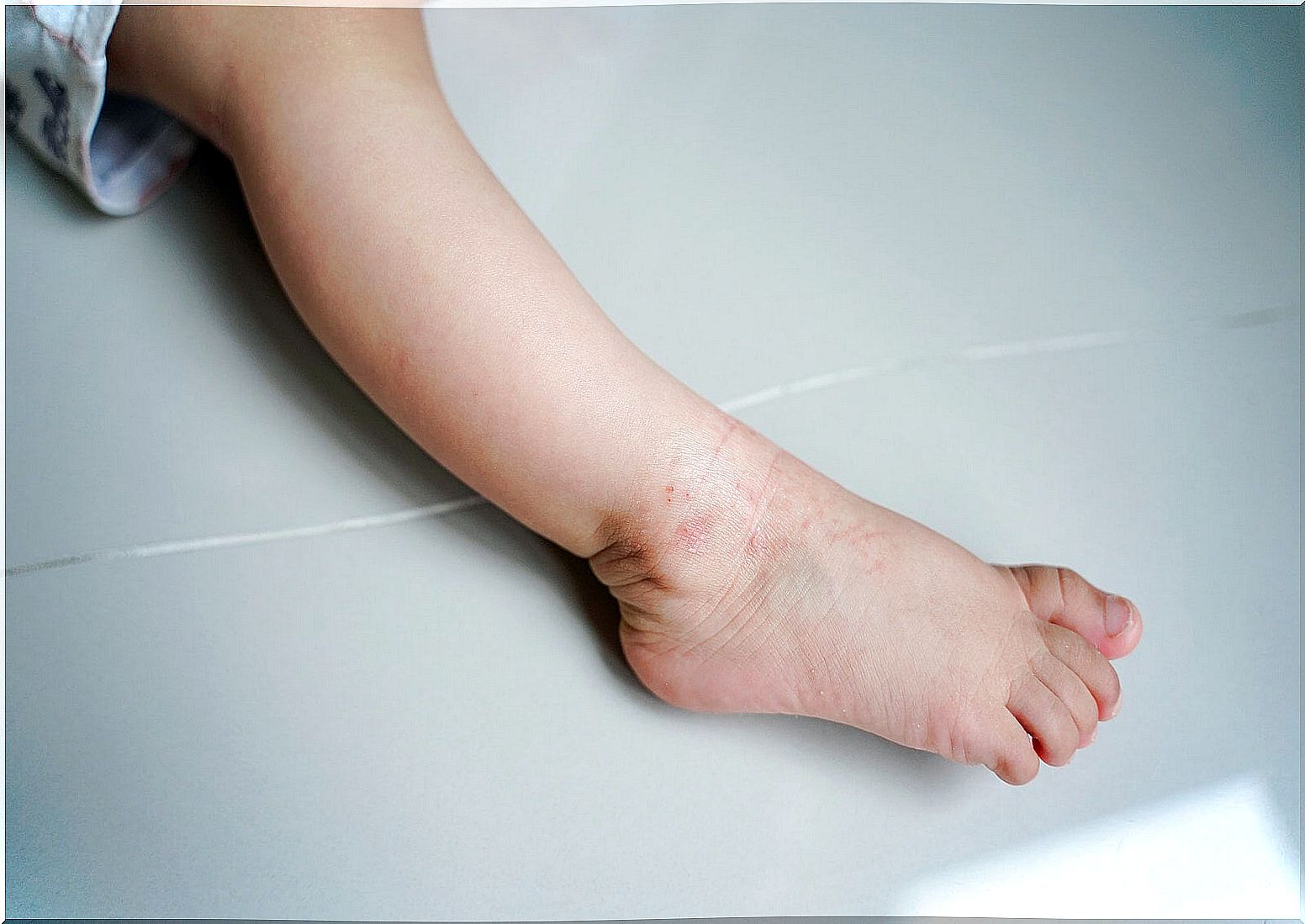 Leg of a child with atopic dermatitis, one of the most common skin diseases in children.