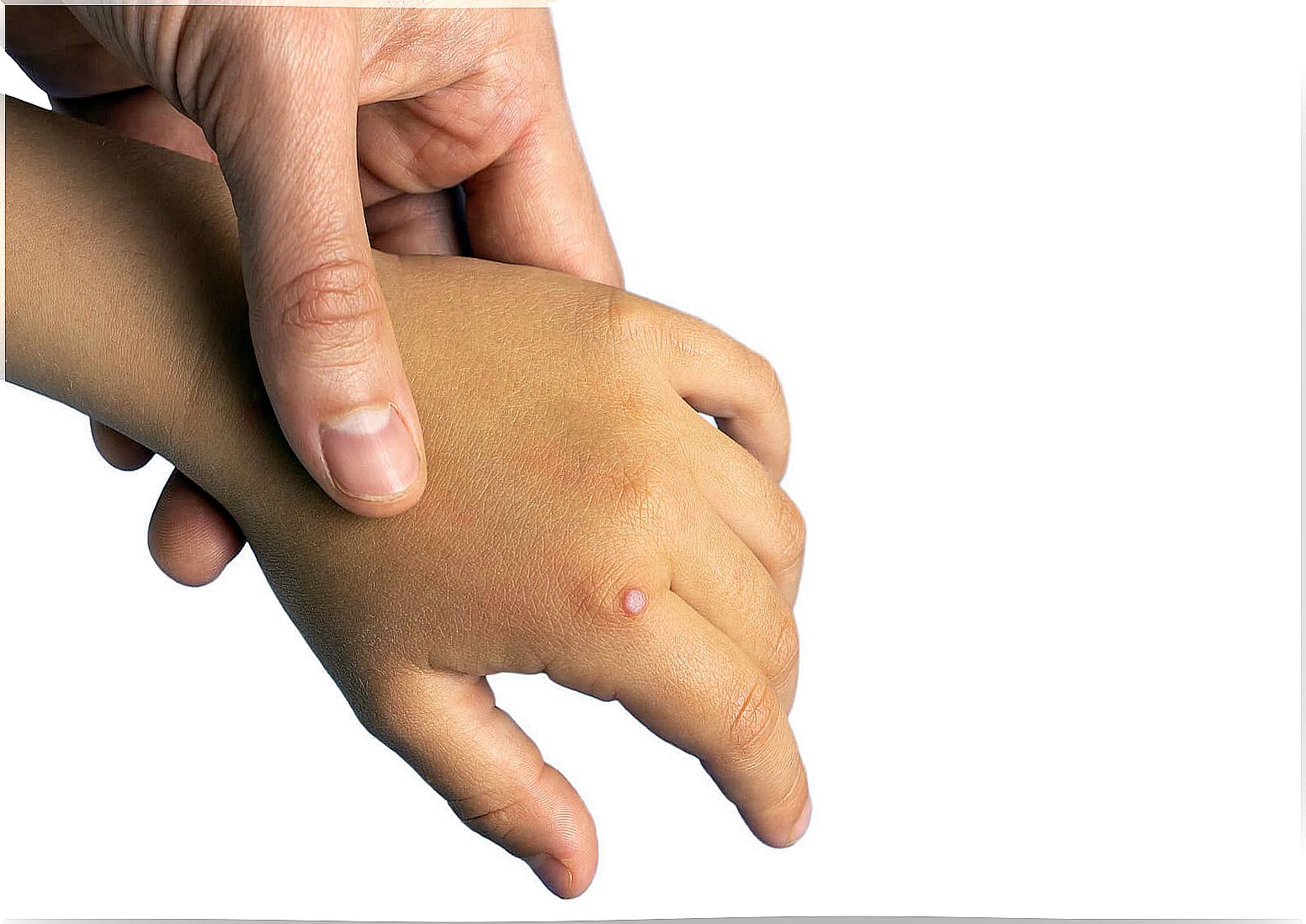 Hand of a child with warts.