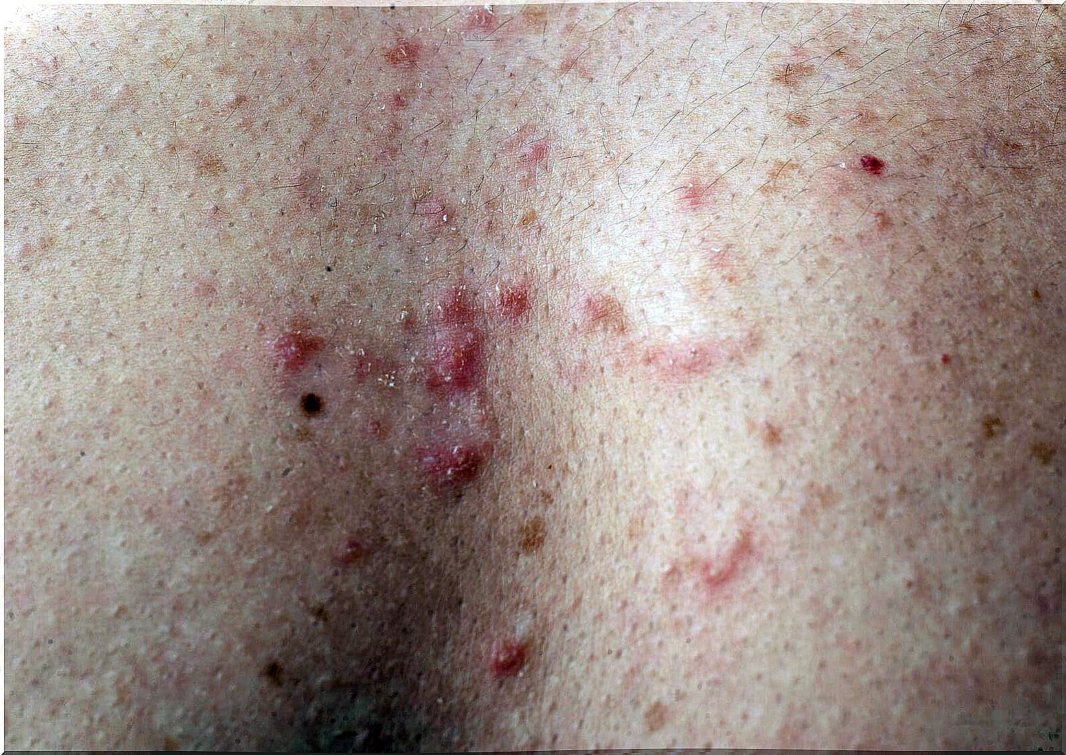 Back of a child with papules.